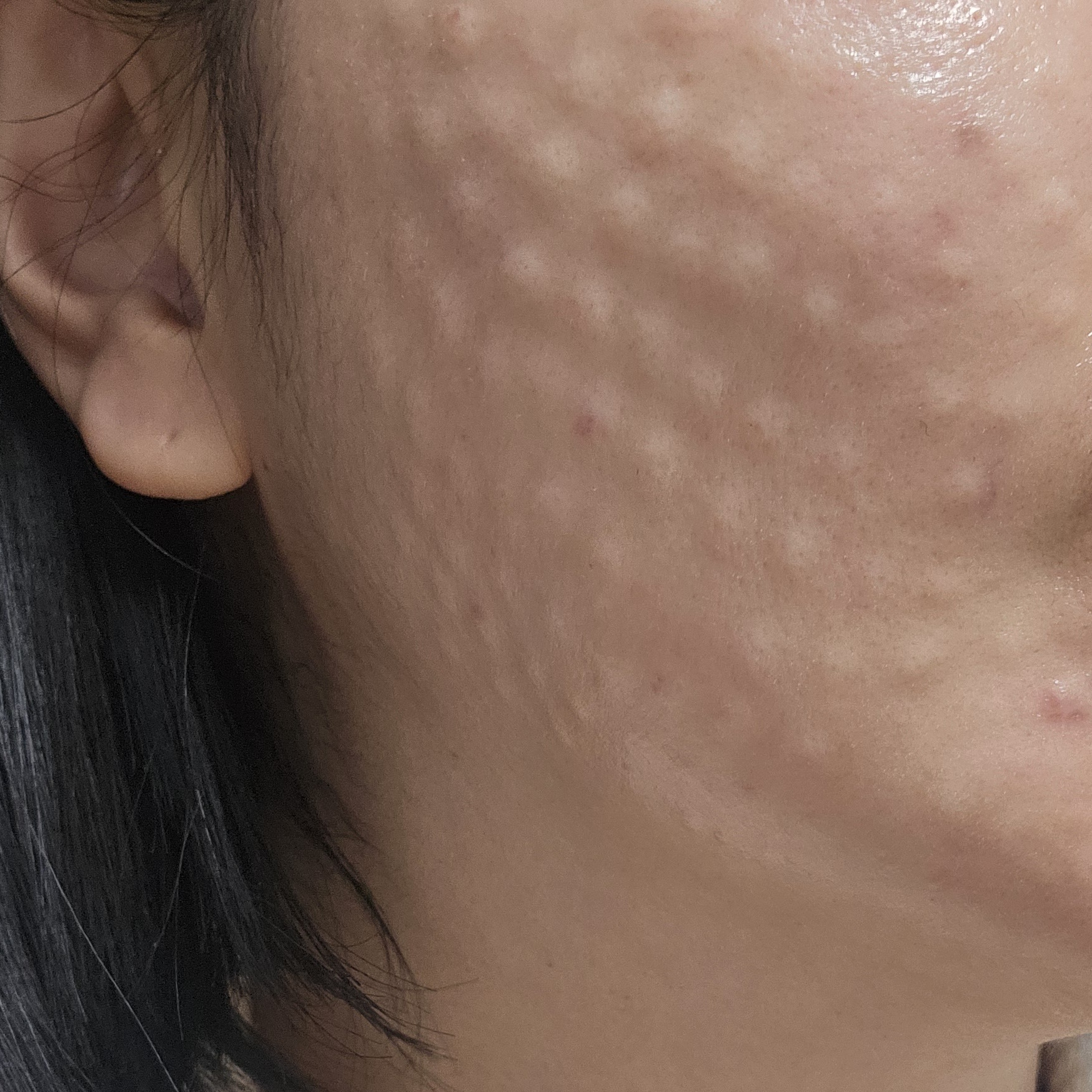 리투오 효과, 부작용? 대표원장의 <분석>