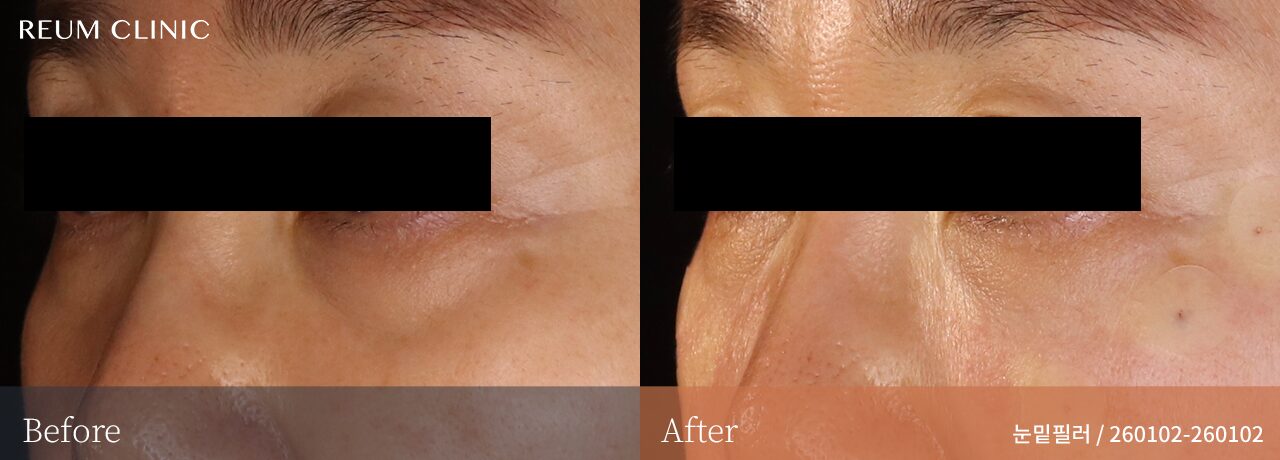 대전눈밑필러 대전둔산동 눈밑필러 40대