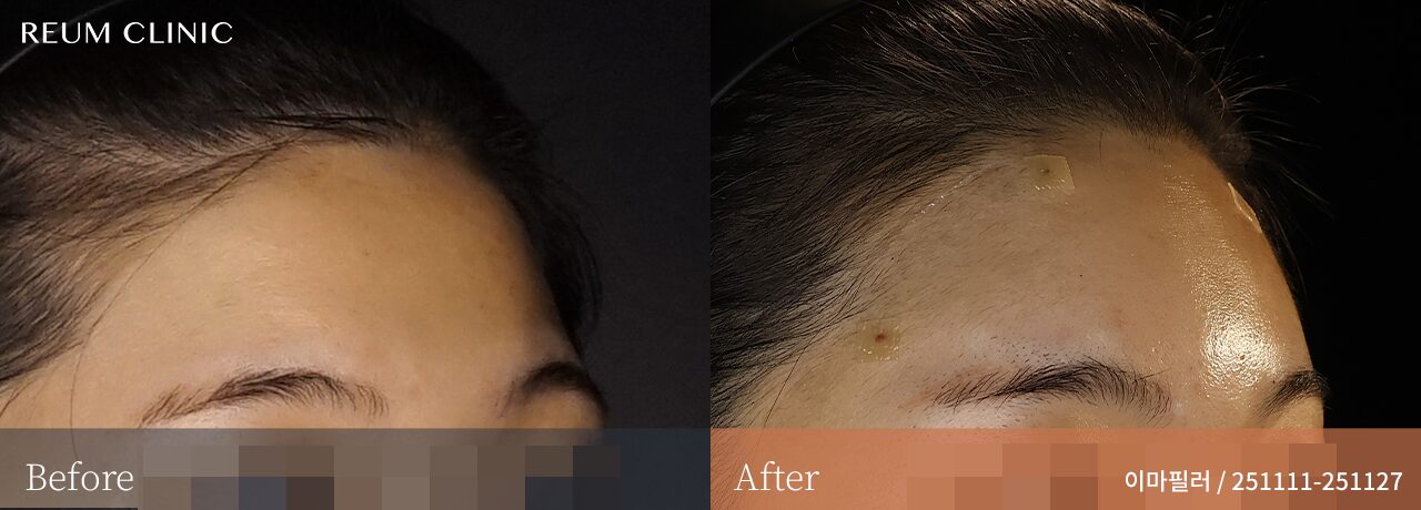 대전 둔산동 이마필러 잘하는곳 20대 여성