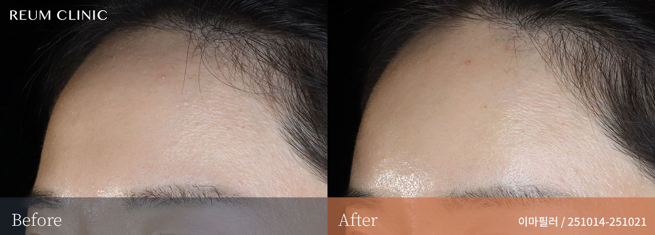 대전 둔산동 이마필러 잘하는곳 30대 여성