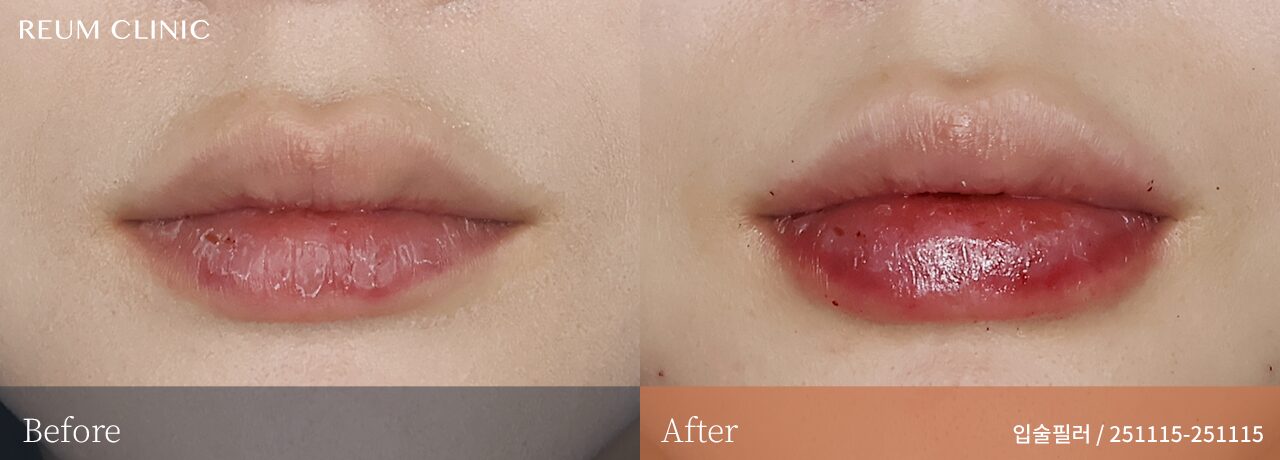 대전 둔산동 입술필러 20대 입술필러