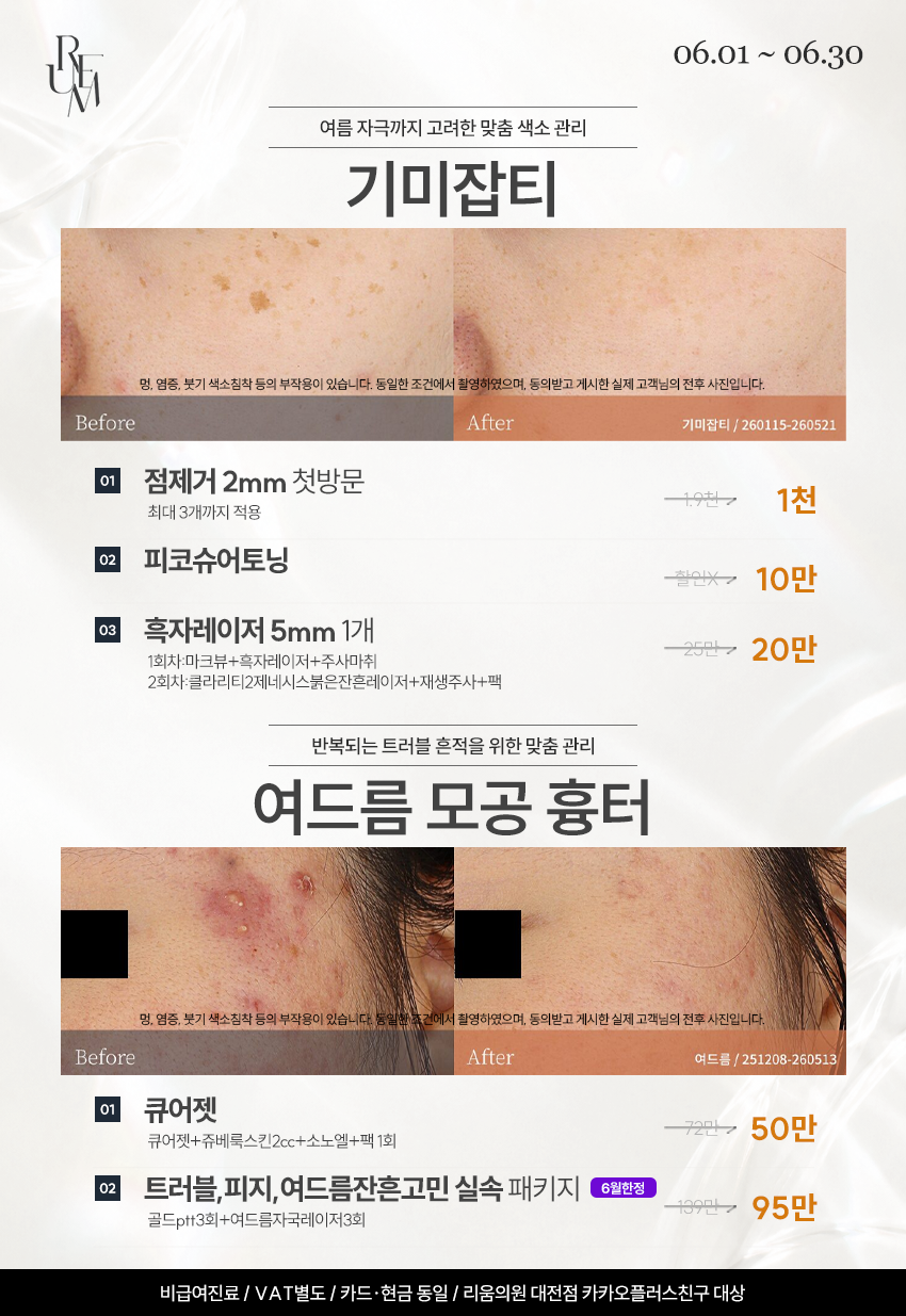 기미잡티/여드름